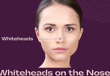 Whiteheads on the Nose