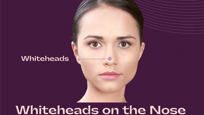 Whiteheads on the Nose