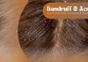 Dandruff and Acne