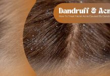 Does Dandruff Cause Acne? Relationship and Treatment Dandruff and Acne