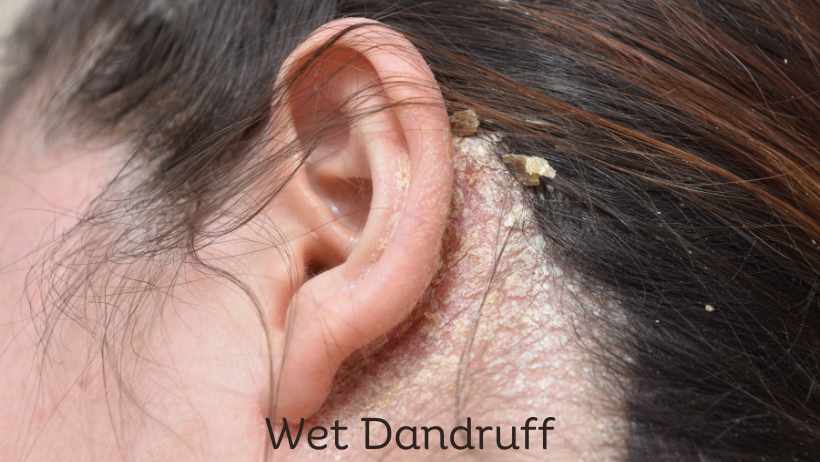 Wet Dandruff