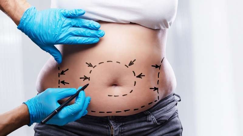 Tummy Tuck Treatment Service at best price in Himatnagar