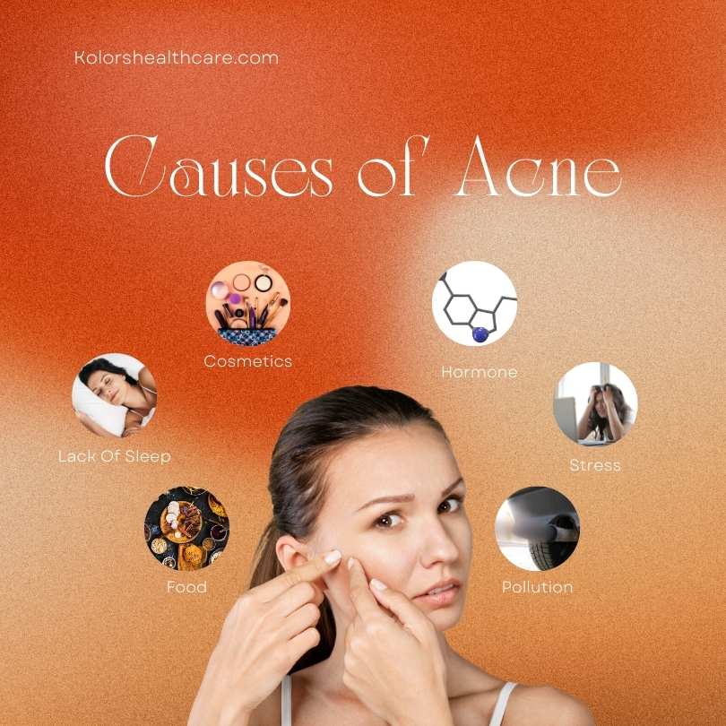 Causes of Acne