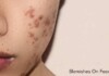 Blemishes On Face