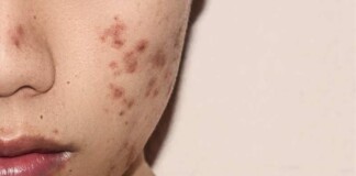 Blemishes On Face