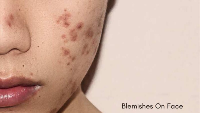 Blemishes On Face