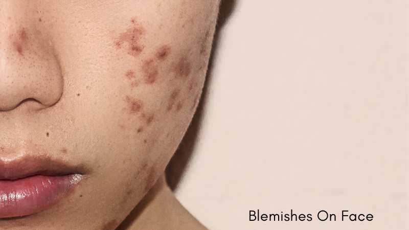 Blemishes On Face