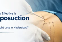How Effective Is Liposuction for Weight Loss in Hyderabad? How Effective Is Liposuction for Weight Loss in Hyderabad?