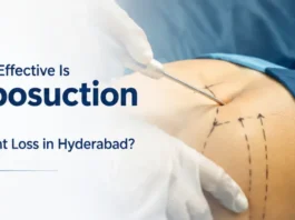 How Effective Is Liposuction for Weight Loss in Hyderabad? How Effective Is Liposuction for Weight Loss in Hyderabad?