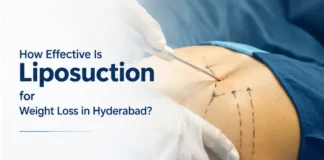 How Effective Is Liposuction for Weight Loss in Hyderabad?